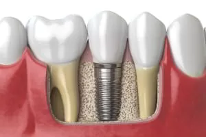 Anatomy of healthy teeth and tooth dental implant