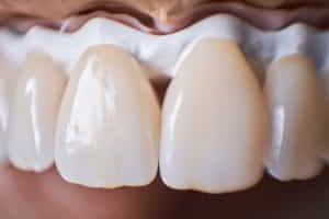 Veneers on a cast