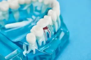 Dental model with root highlighted in red